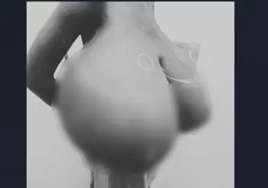 KNH successfully removes 20KG of breast tissue from teen with Gigantomastia